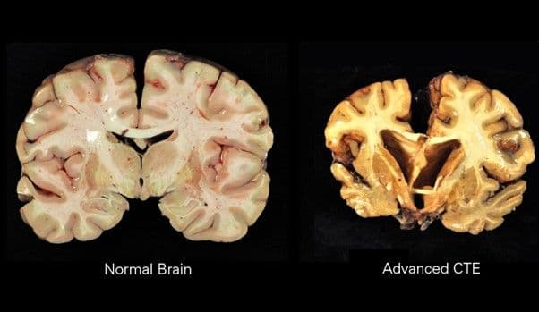 Image Credits: Boston University Center for the Study of Traumatic Encephalopathy